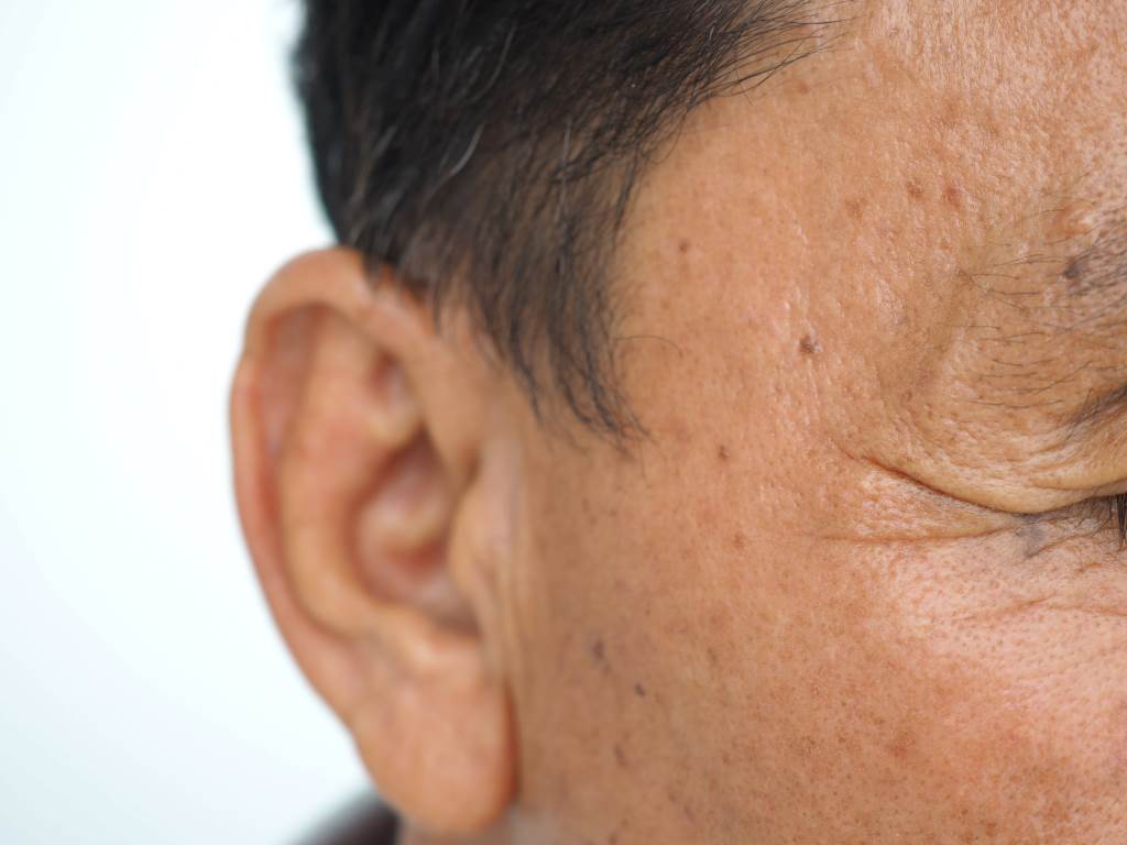 Tiêm Botox để xóa vết nhăn