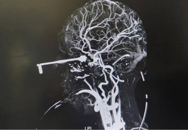 Bé 3 tuổi bị kim móc đâm xuyên não, bác sĩ nhấn mạnh “3 nguyên tắc sơ cứu” cha mẹ tuyệt đối phải nhớ