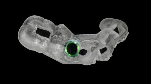 Máng hướng dẫn phẫu thuật cá nhân hóa