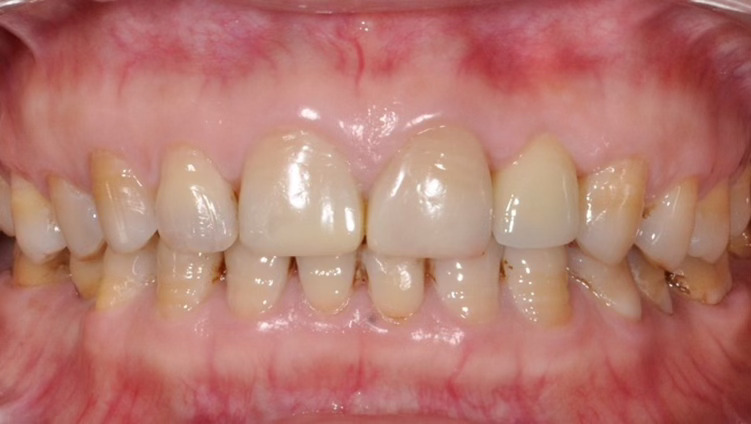 3 yếu tố CỰC QUAN TRỌNG giúp 1 ca cấy ghép implant thành công mỹ mãn