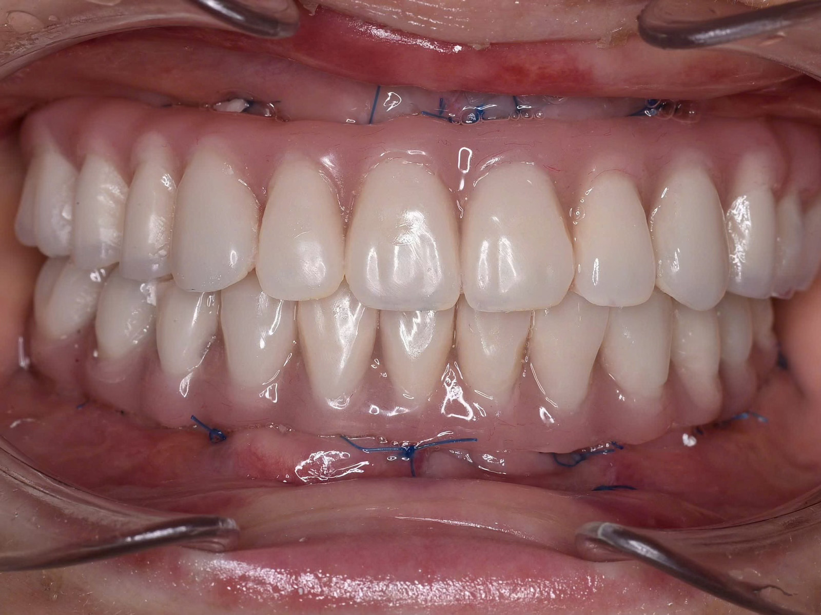 Cấy ghép Implant toàn hàm và phục hình tức thì sau 24h tại Nha Khoa Như Ngọc (21 Trần quang diệu, Hà Nội)