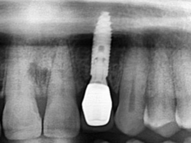 Phục hồi trên implant tại vùng thẩm mỹ như răng thật tại Nha Khoa Như Ngọc (21 Trần quang diệu, Hà Nội).