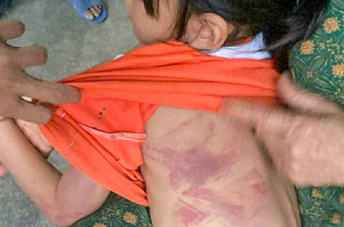 Hình ảnh bé gái bị đánh bầm tím lưng. Ảnh: VnExpress