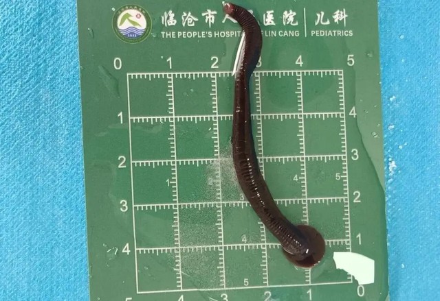 Rùng mình: Bé 8 tuổi ở Trung Quốc được lấy ra con đỉa sống dài 8cm trong khí quản, trước đó từng lấy ra 1 con  từ mũi