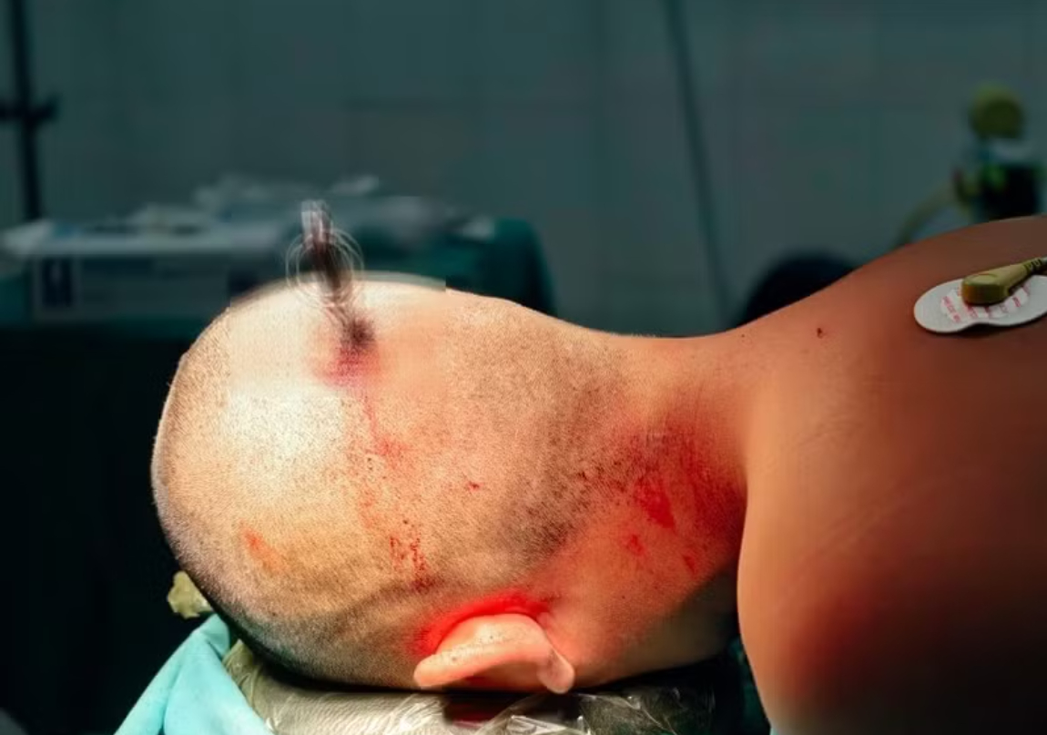 Chiếc chìa khóa cắm sâu vào đầu nam sinh