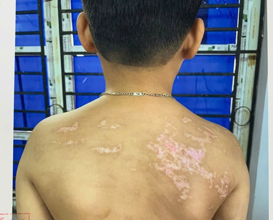 Những thương tích trên cơ thể bé trai do bị bố đánh