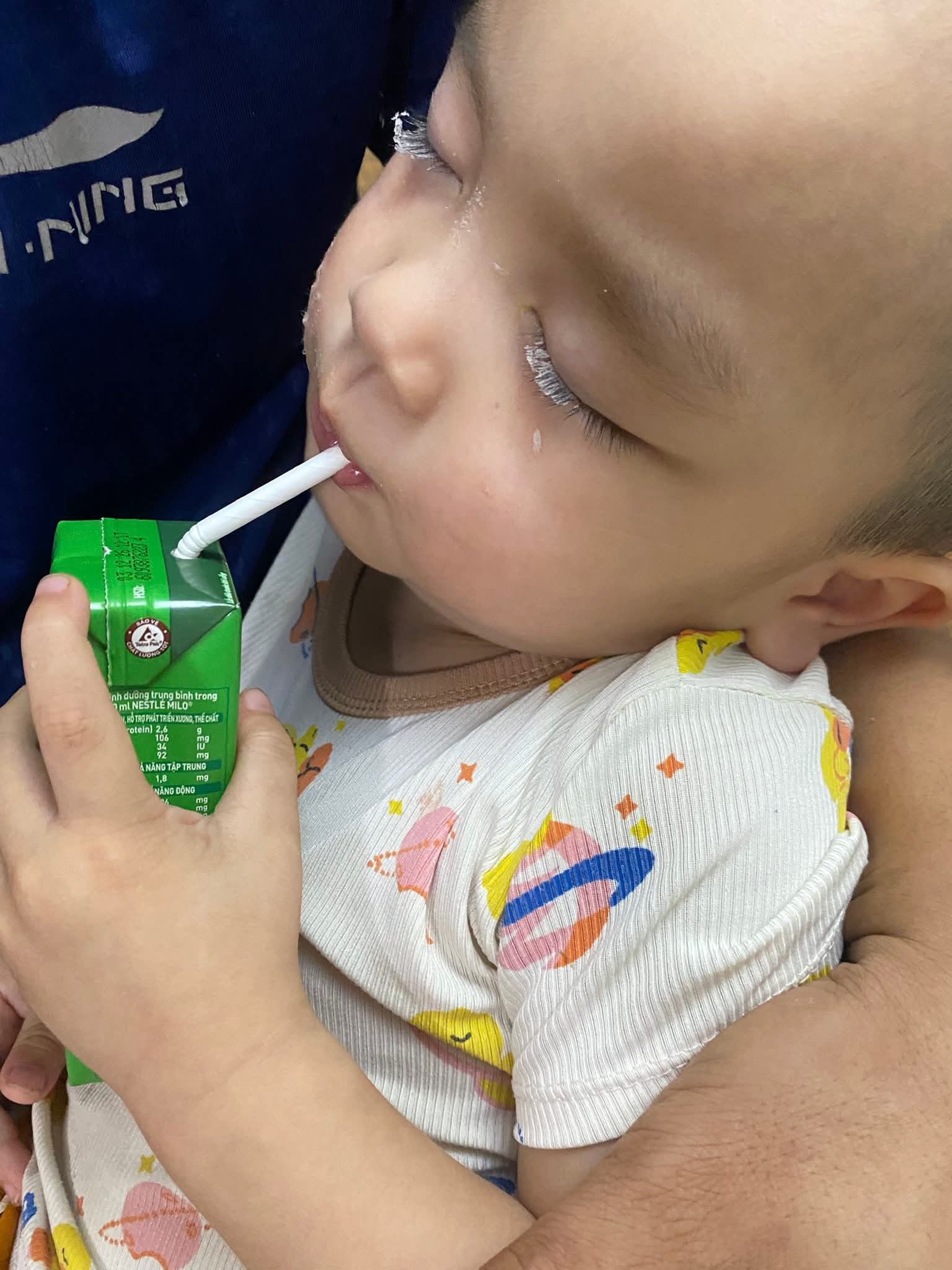 Suýt hối hận cả đời vì vài phút lơ đễnh: Lại thêm 1 em bé bị keo 502 dính vào mắt