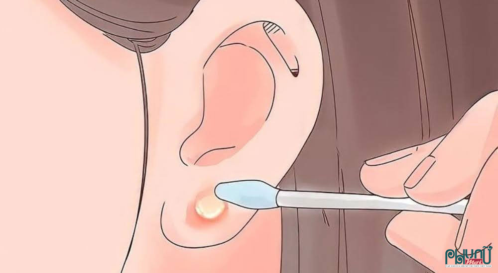 Cách chữa bấm lỗ tai bị mưng mủ tại nhà