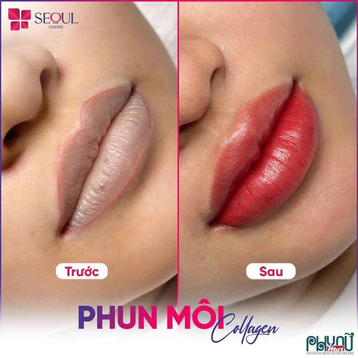 Hình ảnh đôi môi trước và sau của khách hàng sau khi thực hiện phun môi collagen tại Seoul Center
