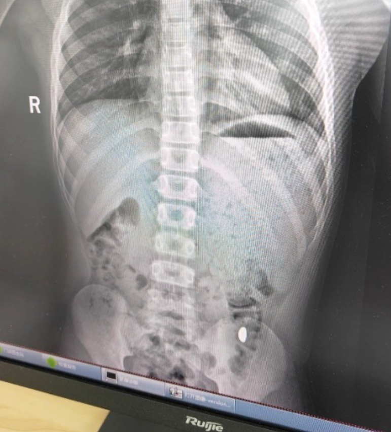 Ảnh chụp X-quang của cậu bé nghịch ngợm