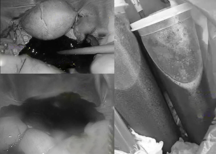 Tổng lượng máu trong khoang bụng do vỡ hoàng thể là 1,5 lít (Ảnh BV cung cấp)