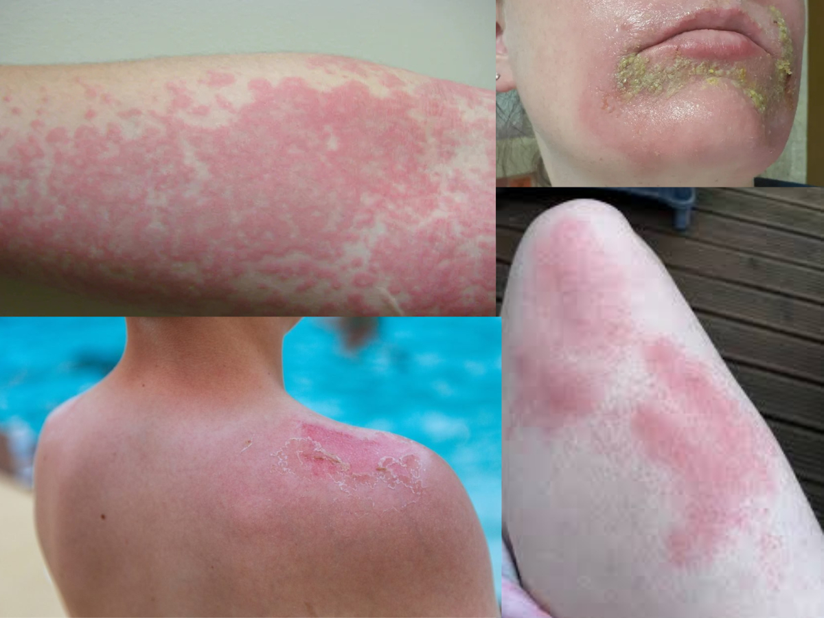 Hội chứng rối loạn máu protoporphyria erythropoietic thường được gọi là bệnh