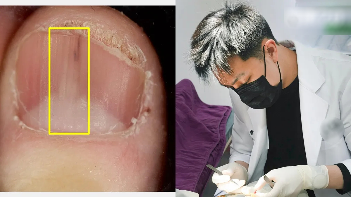 Người phụ nữ 45 tuổi phát hiện khối u từ 1 dấu hiệu ở móng tay nhiều người bỏ qua