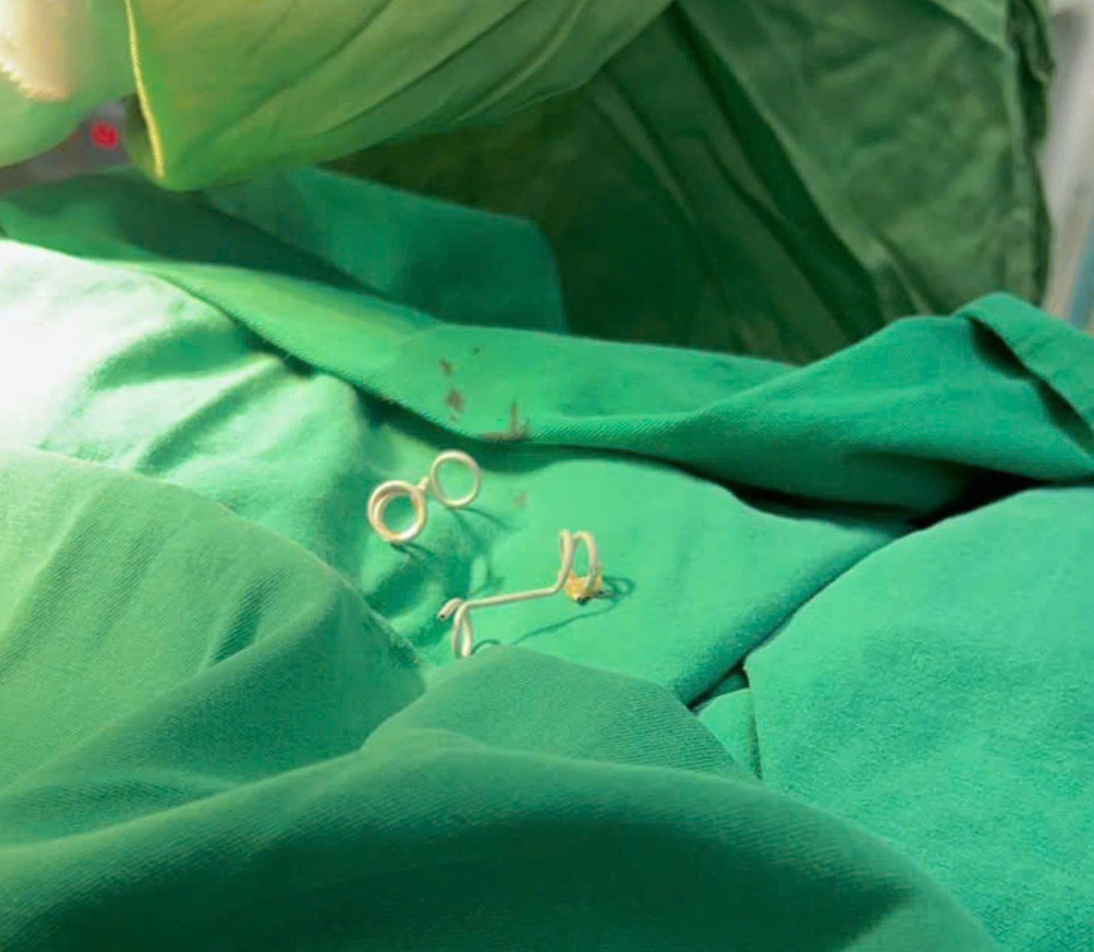   Hình ảnh 2 chiếc ống shunt - một thiết bị dẫn lưu y khoa chuyên dụng giúp em bé an toàn đến với thế giới  