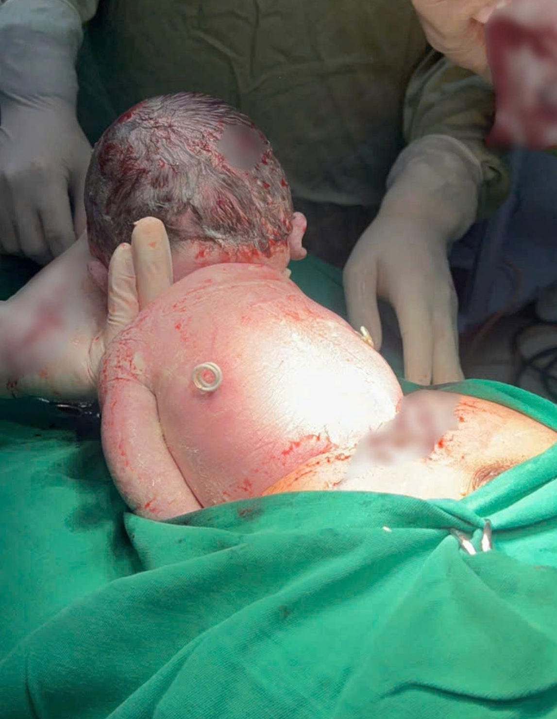 Cả gia đình và đội ngũ y bác sĩ đều xúc động mạnh trước hình ảnh kiên cường của em bé với 