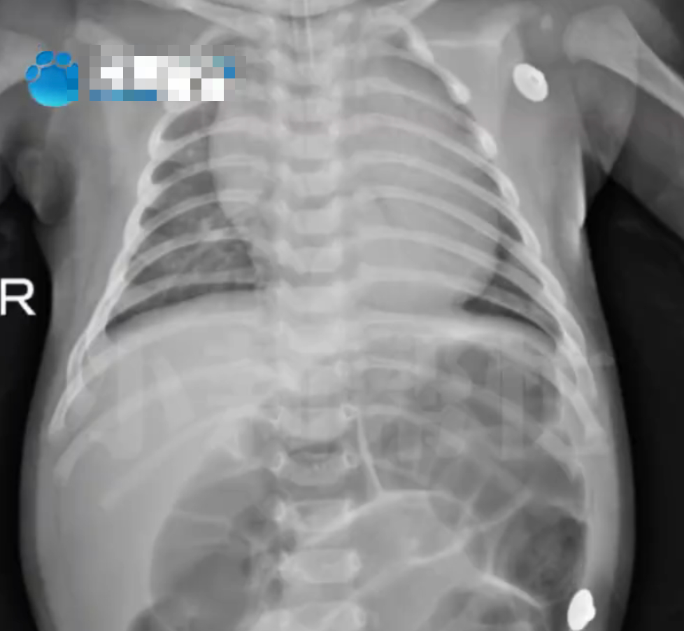 Em bé 52 ngày tuổi nhập viện trong tình trạng bụng phình to, suy hô hấp vì ngộ độc Botulinum