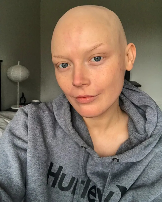 Bệnh ung thư của Georgie Swallow tái phát ở tuổi 29 với mức độ nghiêm trọng hơn