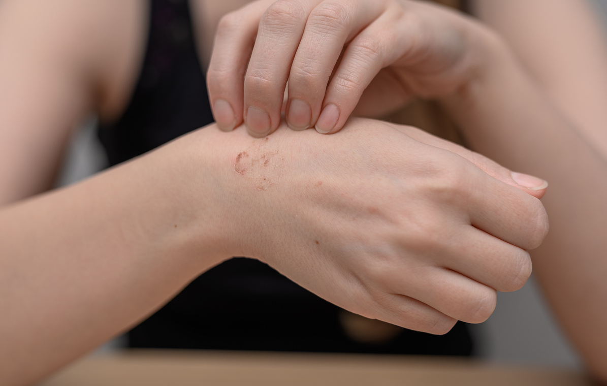 Ngứa da bất thường là một triệu chứng thường gặp của ung thư hạch (Ảnh minh họa)