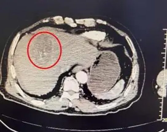 Người phụ nữ 70 tuổi vỡ khối u gan vì nhảy múa 