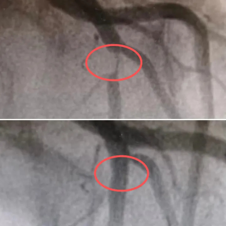 Nữ nhân viên văn phòng mới 27 tuổi mà 95% động mạch vành đã tắc nghẽn vì thói quen nhiều người làm mỗi ngày