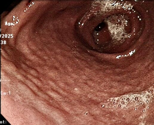 Hình ảnh nội soi dạ dày nam sinh