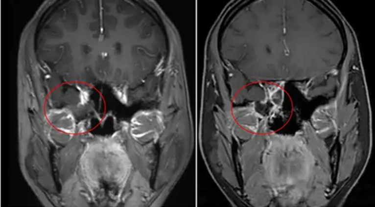 Chảy “nước mũi” suốt 20 ngày, người phụ nữ bất ngờ khi phát hiện… não bị rò rỉ