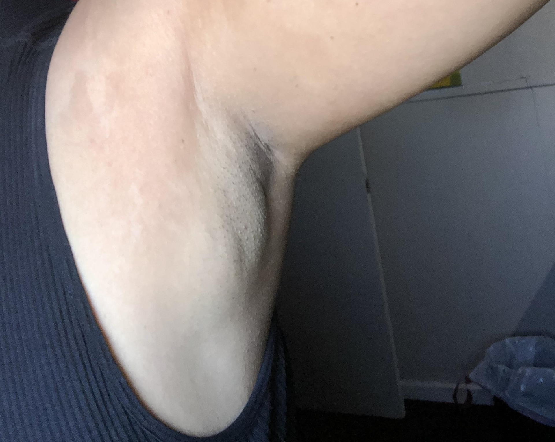 Sưng hạch ở nách, cổ hay bẹn nhiều tuần là triệu chứng quan trọng khi mắc u lympho (Ảnh minh họa - không phải nhân vật)