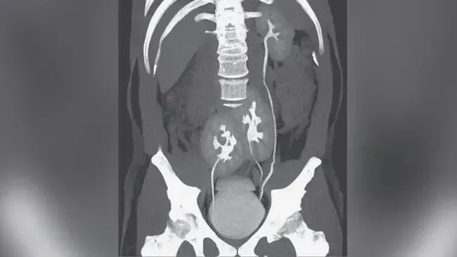 Đi khám nhiễm trùng tiết niệu, người đàn ông 31 tuổi phát hiện có 3 quả thận