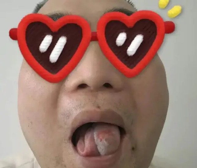 Người đàn ông 41 tuổi nhiệt miệng 2 tháng không khỏi, đi khám phát hiện ung thư lưỡi 