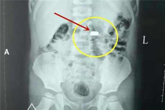 Viên pin cúc áo mà bé trai 3 tuổi của chị Linlin nuốt phải gây nguy hiểm dù tới bệnh viện ngay sau đó