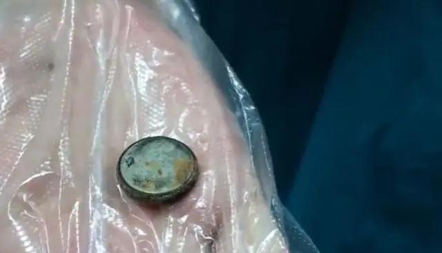 Ngay cả khi được lấy ra thành công, việc nuốt phải pin cúc áo vẫn để lại di chứng