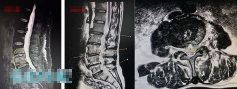 2 vợ chồng cùng bị đau lưng, đi khám phát hiện xương đã bị