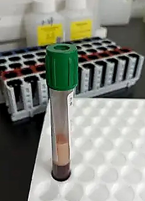 Máu của ông Wang đục như sữa dâu, nổi váng mỡ do viêm tuỵ cấp