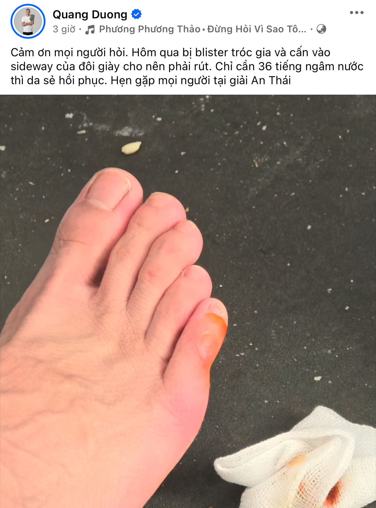 Vết thương khiến Quang Dương không thể thi đấu ở giải Pickleball Lạch Tray mở rộng ngày 9/4 