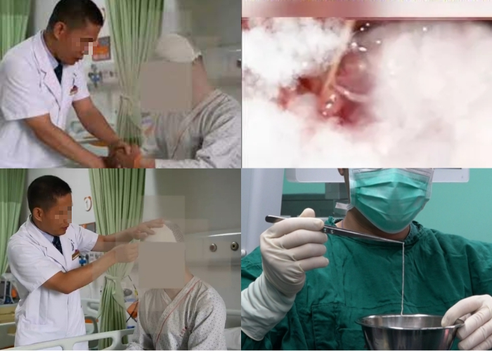 Khi được lấy ra ngoài nhờ phẫu thuật, con sán nhái dài 10 cm vẫn sống, ngoe nguẩy mạnh