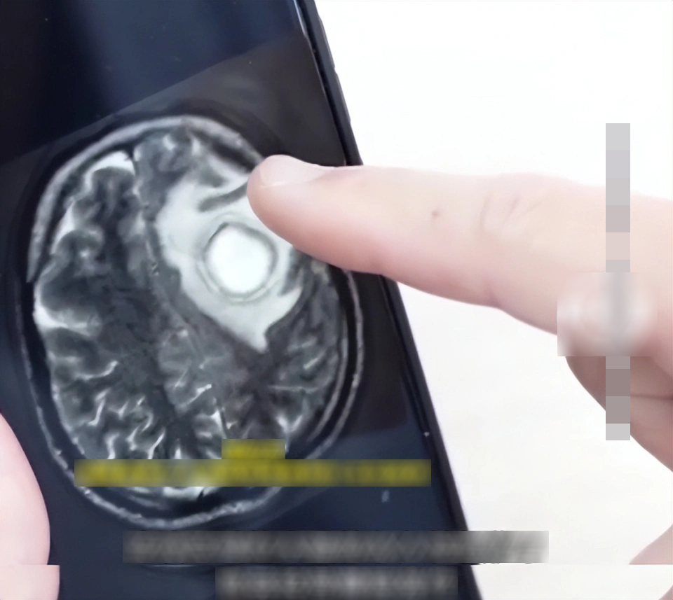 Người đàn ông bị tổn thương não vĩnh viễn vì xì mũi quá mạnh: Bạn có đang làm việc này đúng cách?