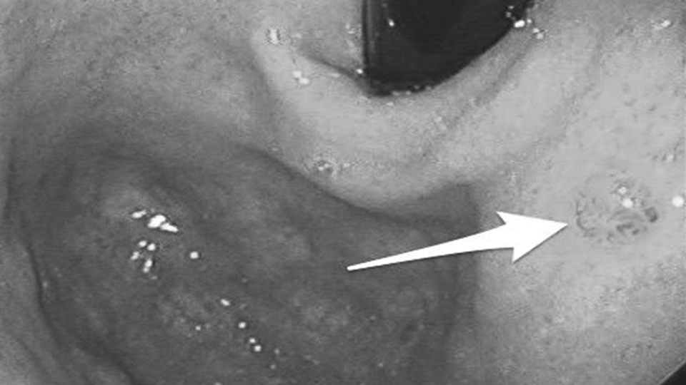 Một năm trước khi mắc ung thư dạ dày, cơ thể sẽ phát ra 4 dấu hiệu cảnh báo, không may là 80% người bệnh lại bỏ qua