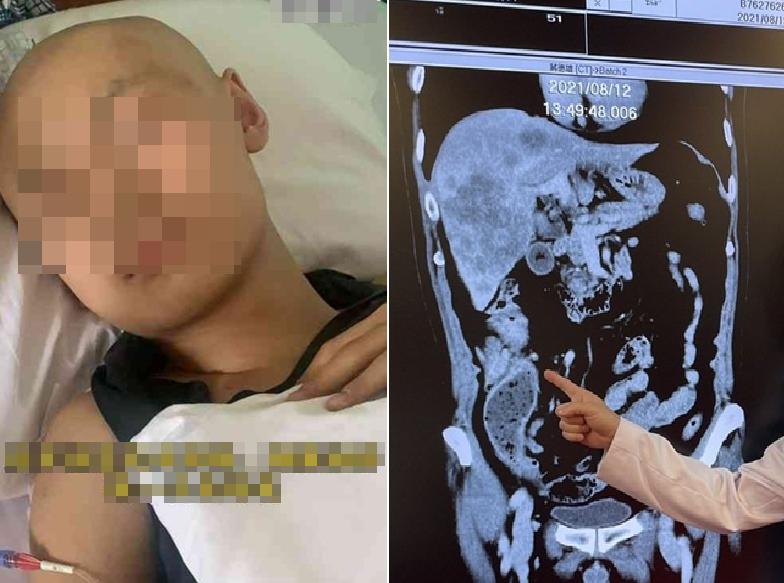 Thiếu niên 18 tuổi mắc ung thư đại trực tràng giai đoạn 3, bác sĩ nhắc: Người trẻ thường bỏ qua 2 dấu hiệu cảnh báo