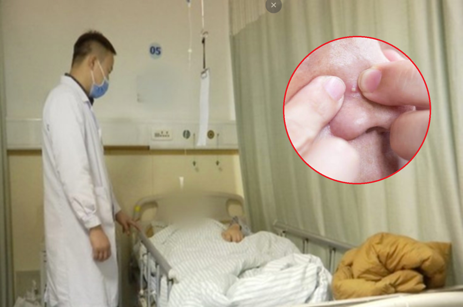 Nặn mụn trên mặt, người đàn ông 51 tuổi phát triển khối u ác tính