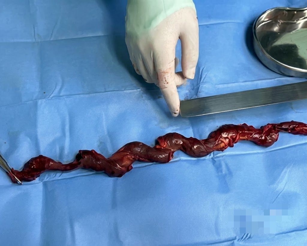 Cục máu đông khổng ồ 40cm được lấy ra khỏi cơ thể người đàn ông 10 năm giãn rtinhx mạch chi dưới (Ảnh minh họa)