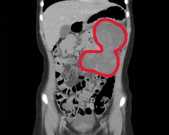 Bé trai 9 tuổi có khối u sarcoma khổng lồ 15cm nguy hiểm trong ổ bụng (Ảnh từ BS)