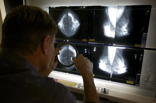 Hiện tại chẩn đoán ung thư vú hầu hết đều thông qua X-quang.