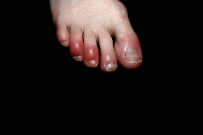   Ngón chân của bệnh nhân nhiễm nCoV nhẹ sưng tấy, chuyển đỏ, cảm giác nóng rát hoặc ngứa ngáy. Ảnh: Science Source  