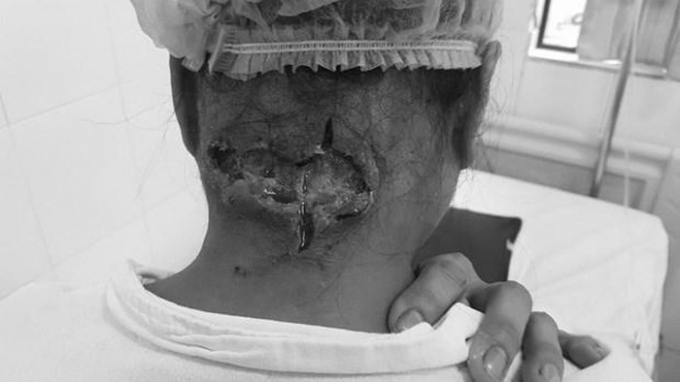   Bệnh nhân nữ được phẫu thuật cắt lọc tổ chức hoại tử. (Ảnh: PV/Vietnam+)  