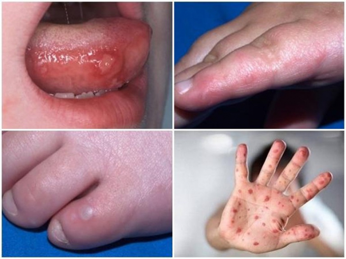 Hơn 300 ca mắc bệnh tay chân miệng từ đầu năm đến nay