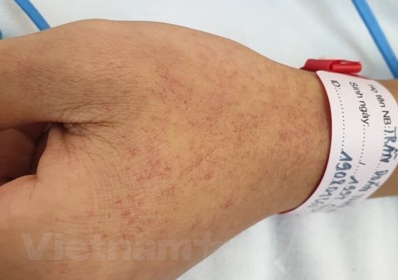 Một trường hợp mắc bệnh sốt xuất huyết tại Bệnh viện Bạch Mai. (Ảnh: T.G/Vietnam+)