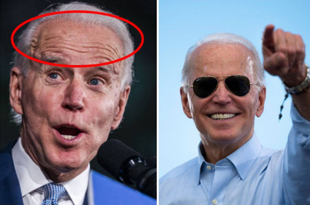   Ông Joe Biden được cho là căng da trán để xóa mờ nếp nhăn.  