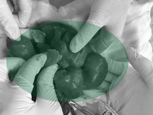 Các bác sĩ đã thực hiện cuộc phẫu thuật cấp cứu bóc thành công khối thai trong ổ bụng bé gái sơ sinh.
