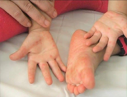 Số ca bệnh tay chân miêng tăng 4 lần so cùng kỳ năm ngoái