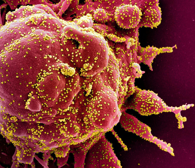   Tế bào nhiễm SARS-CoV-2 (màu vàng).  